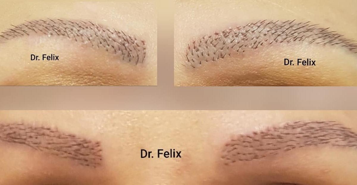 implant de sprancene dr felix
