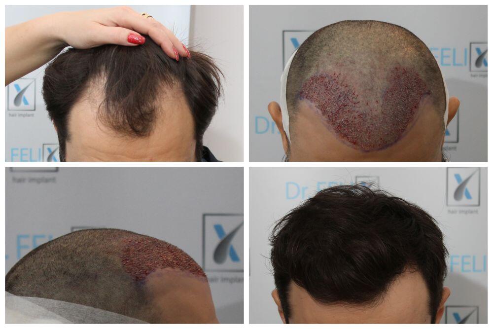 Rezultat Implant de par Q-FUE