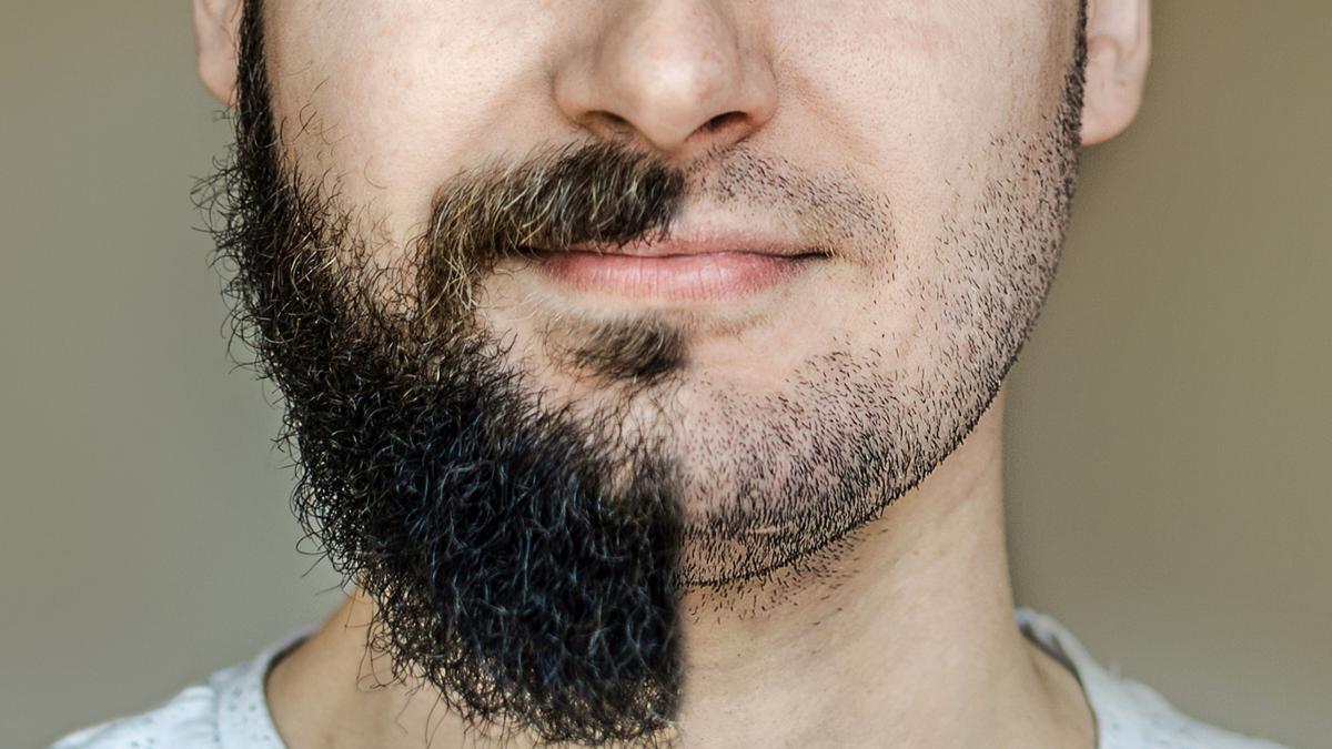 implant de par pentru barba