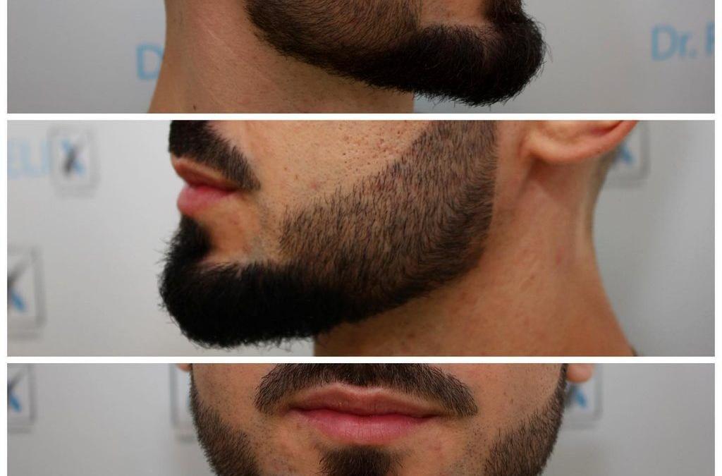 implant de barba si mustata