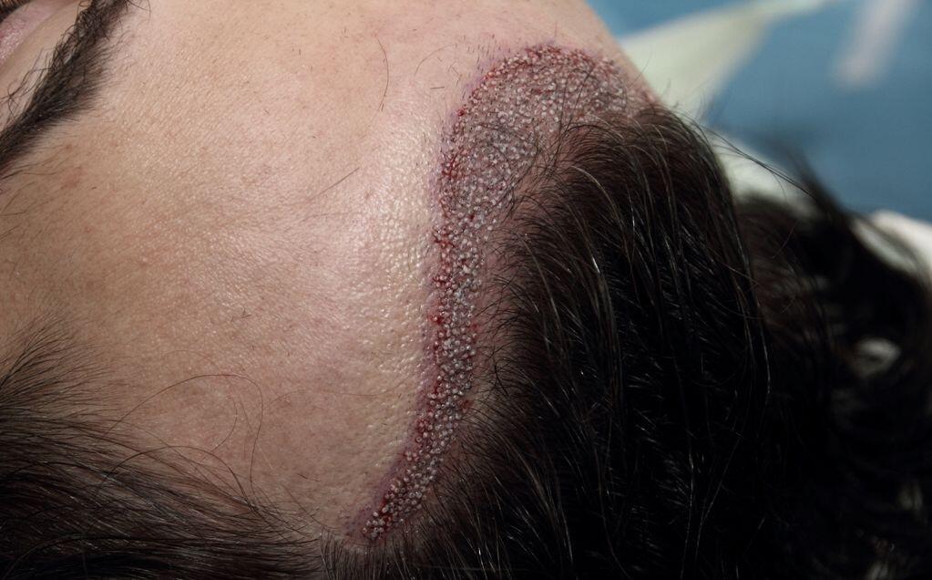 Implant de par fara tuns