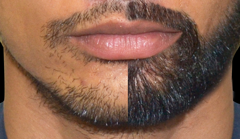 implant de barba
