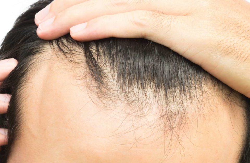 remodelare linie frontala par cu implant de par