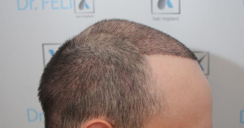 FUE Hair Transplant Results Pictures Before and After | Hair Surgery