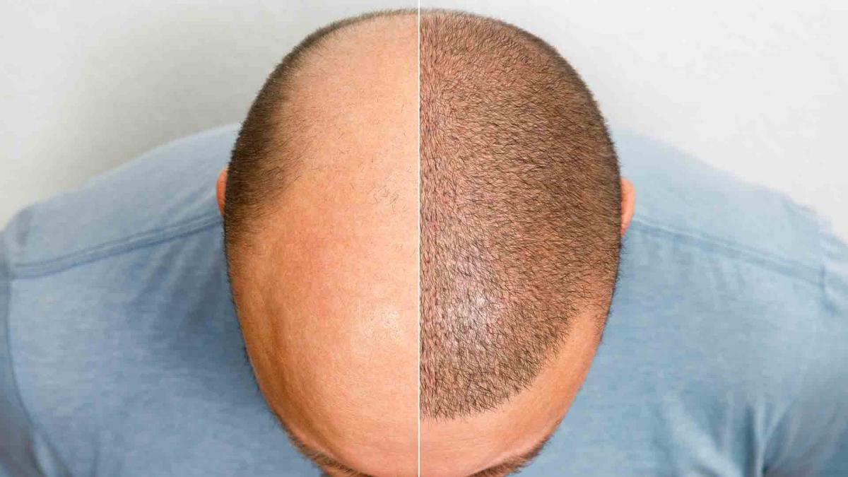 Efecte secundare implant de par