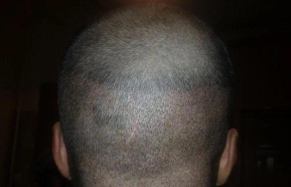 Zona donatoare implant de par