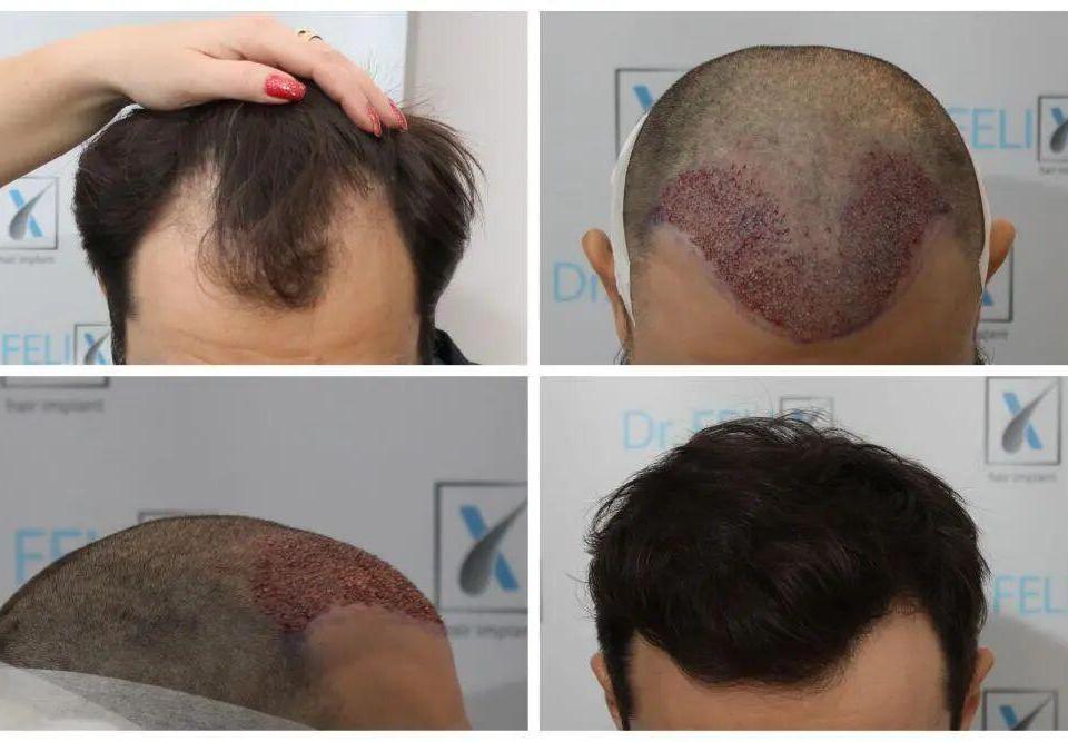 Rezultate implant par