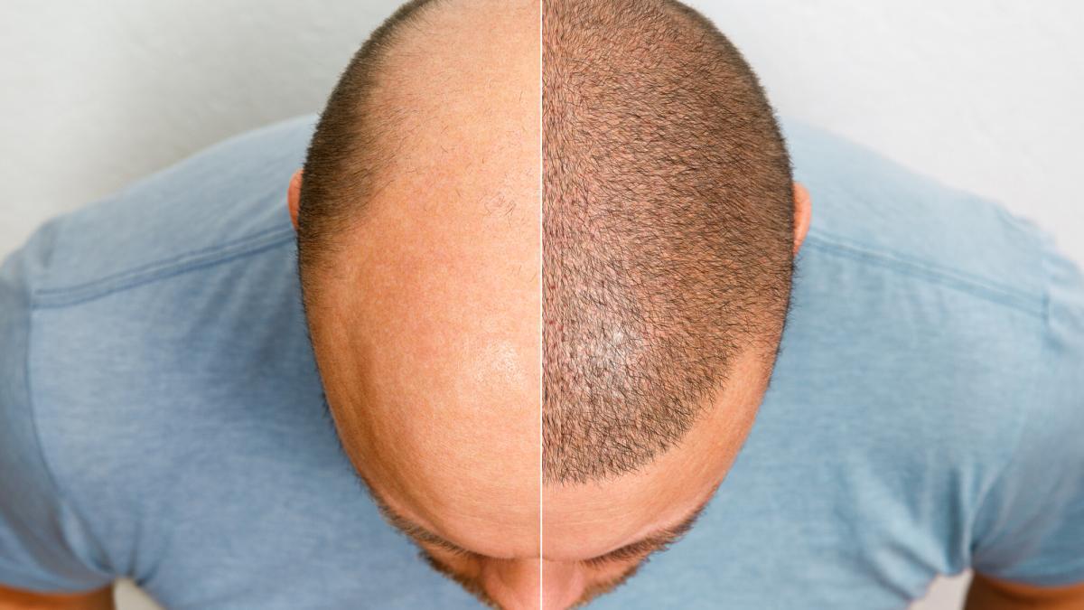 Tratament dupa implant de par