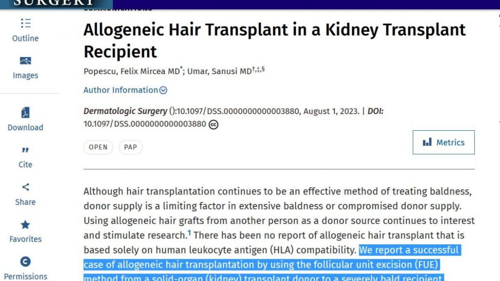 Allogeneic Hair Transplant in a Kidney Transplant Recipient
