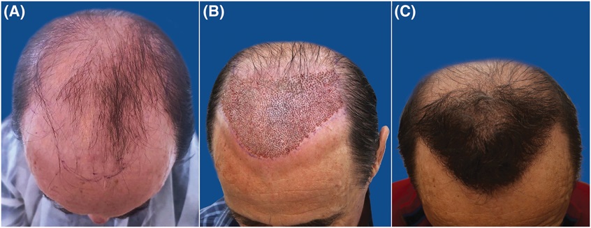 Allogeneic hair transplant from another person