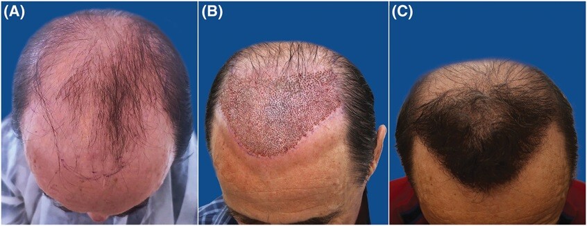 allogeneic hair transplant from another person