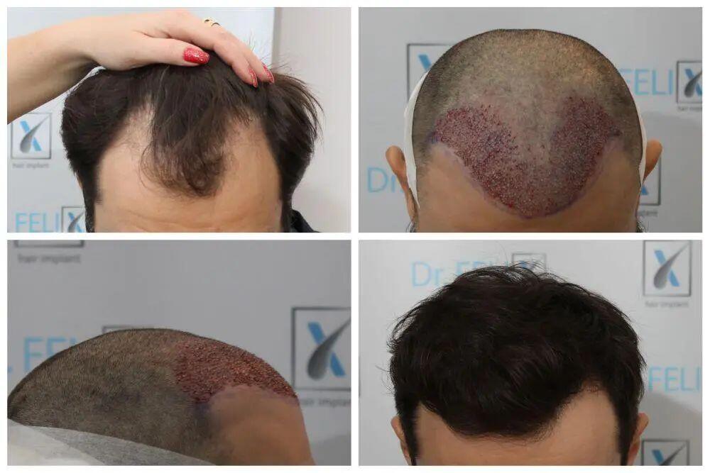 Rezultate implant de par