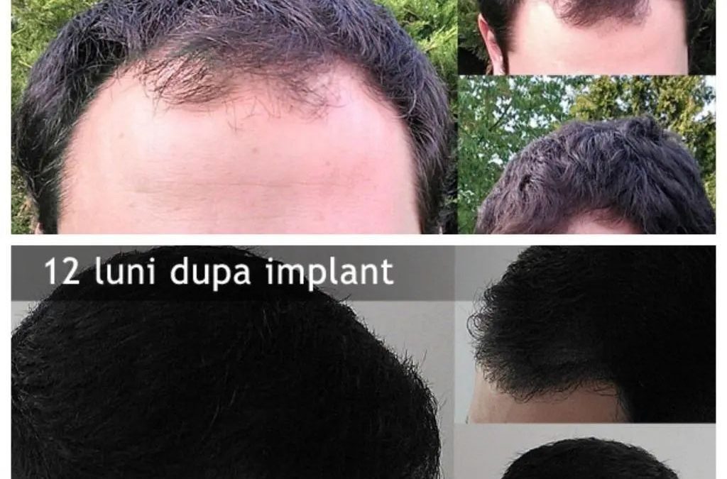 Inainte si dupa implantul de par