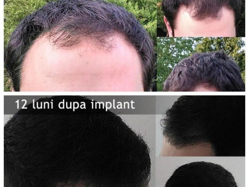 Inainte si dupa implantul de par