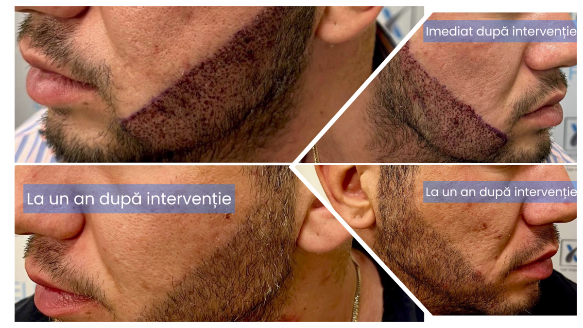 Implant de par pentru indesire sau contur barba barbati