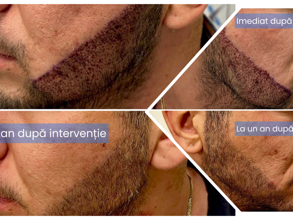 Implant de par pentru indesire sau contur barba barbati