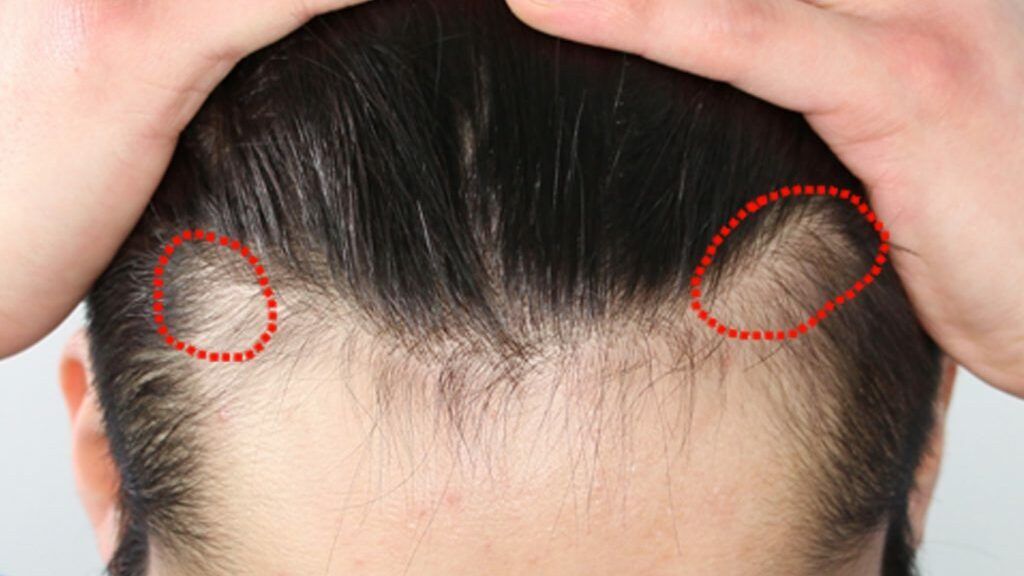 Alopecia de tractiune tratament