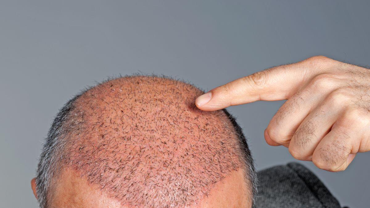 Densitatea parului dupa implant