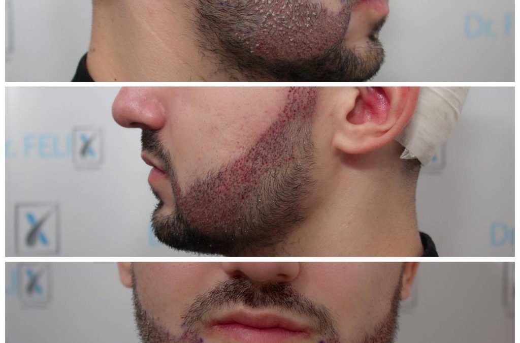 cat costa implantul de barba