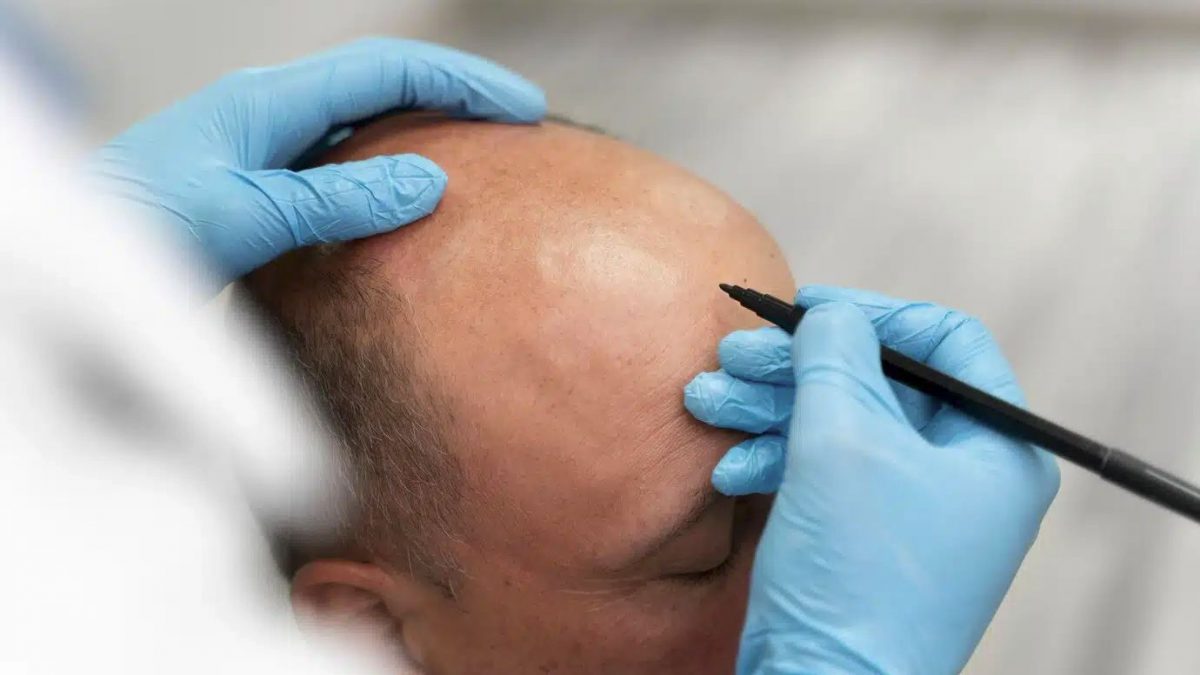 alopecia dupa un implant de par reusit
