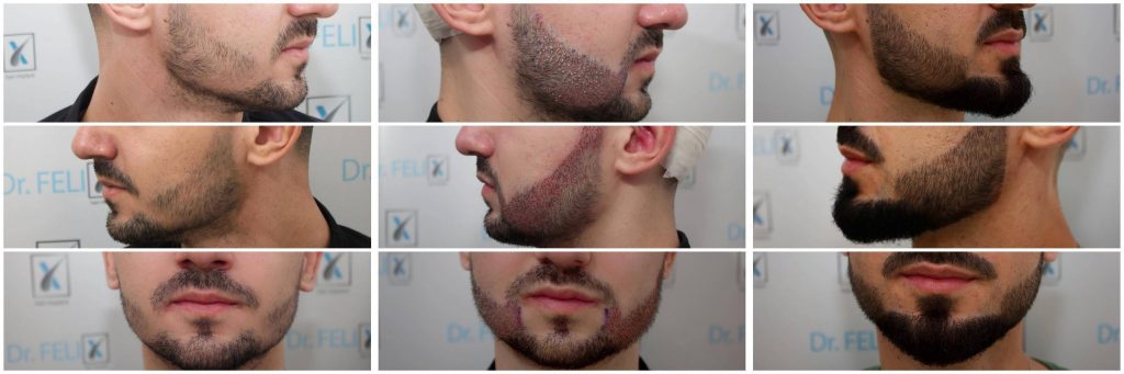 Implant de barba - caz clinic inainte si dupa Implant de barba - caz clinic inainte si dupa