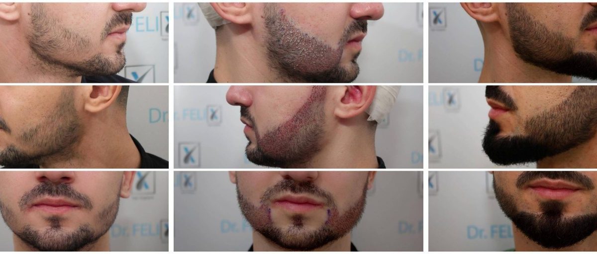 Implant de barba: cum se face, ce durata are si cand merita facut?