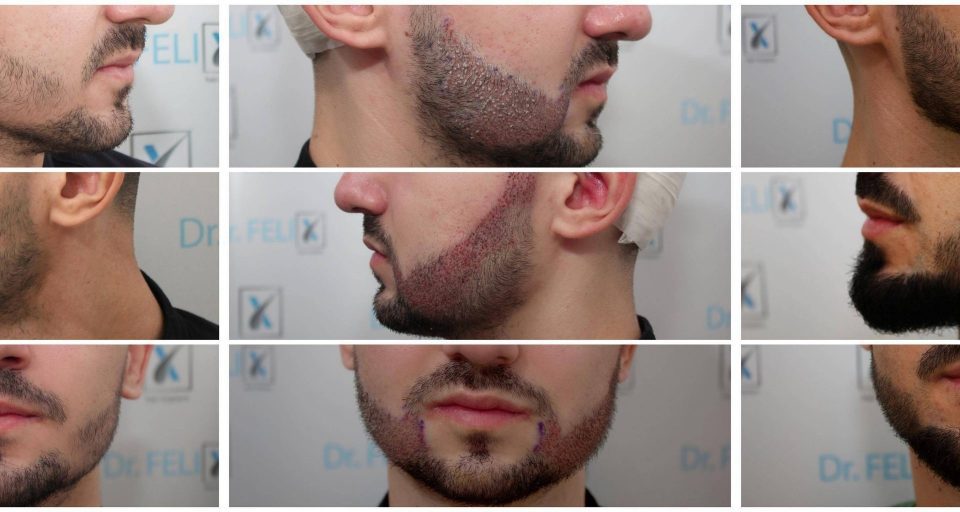 Inainte si dupa implant de par pentru barba