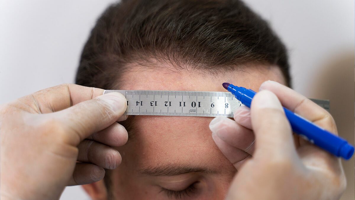 Greseli frecvente observate la prima consultatie pentru implantul de par