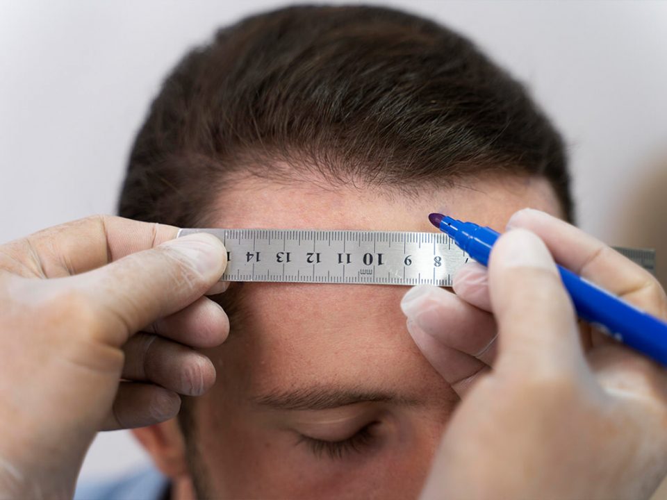 Greseli frecvente observate la prima consultatie pentru implantul de par