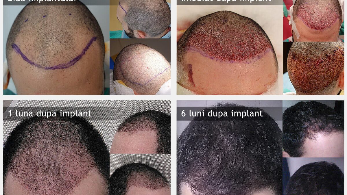 De la consultatie la rezultat: cum arata traseul pacientului la o clinica specializata in implant de par