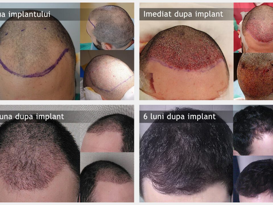 De la consultatie la rezultat: cum arata traseul pacientului la o clinica specializata in implant de par