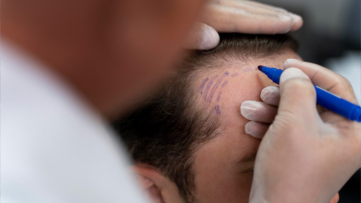 persoana-ce-se--pregateste-de-implant-de-par