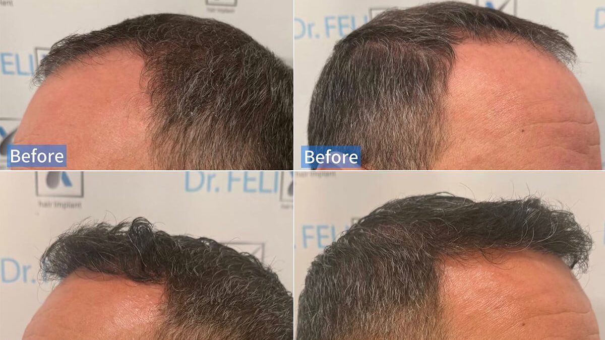 implant de par barbat before and after 7 months