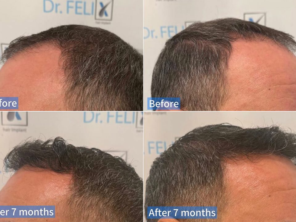 implant de par barbat before and after 7 months