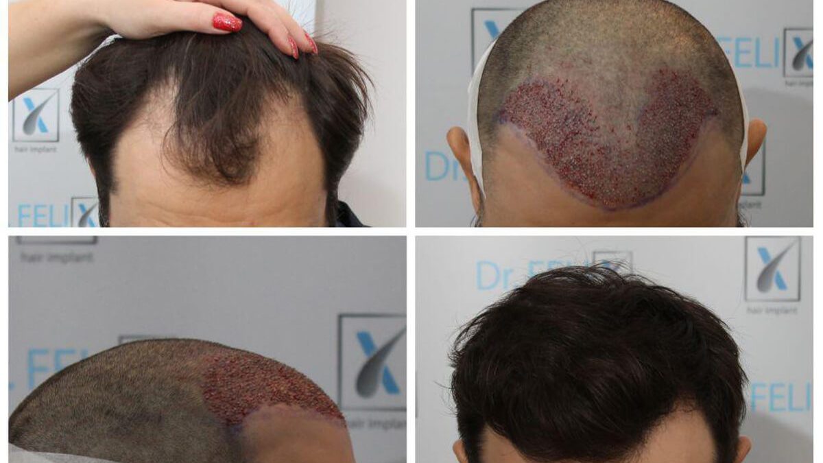 implant-de-par-linia-parului-barbati