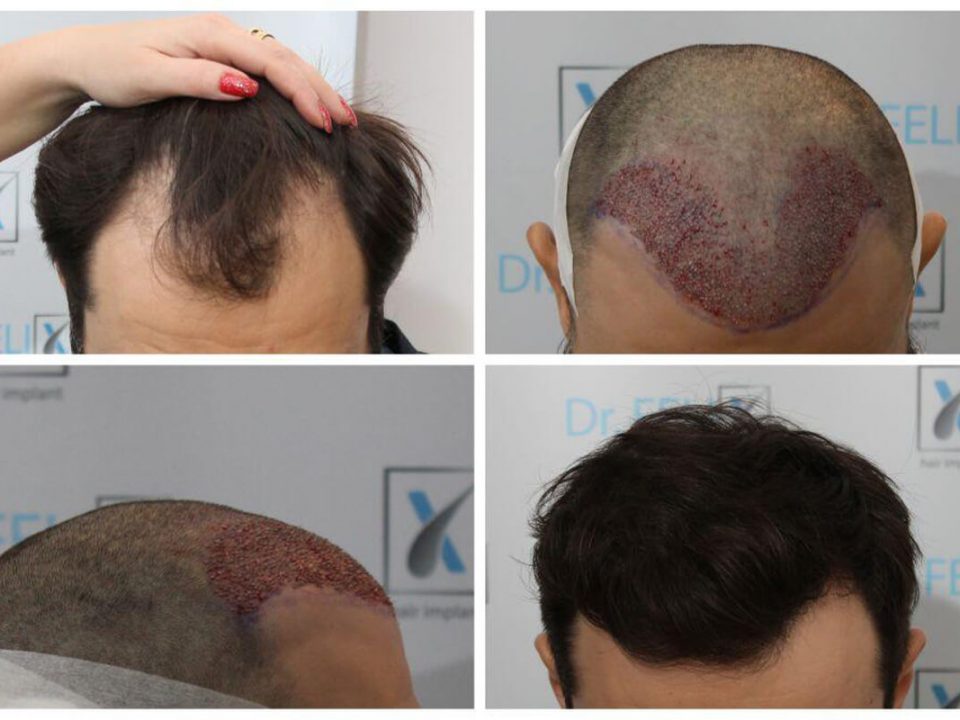implant-de-par-linia-parului-barbati